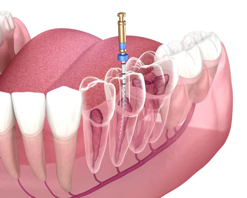 Endodonție