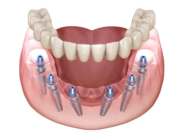 Implant clasic