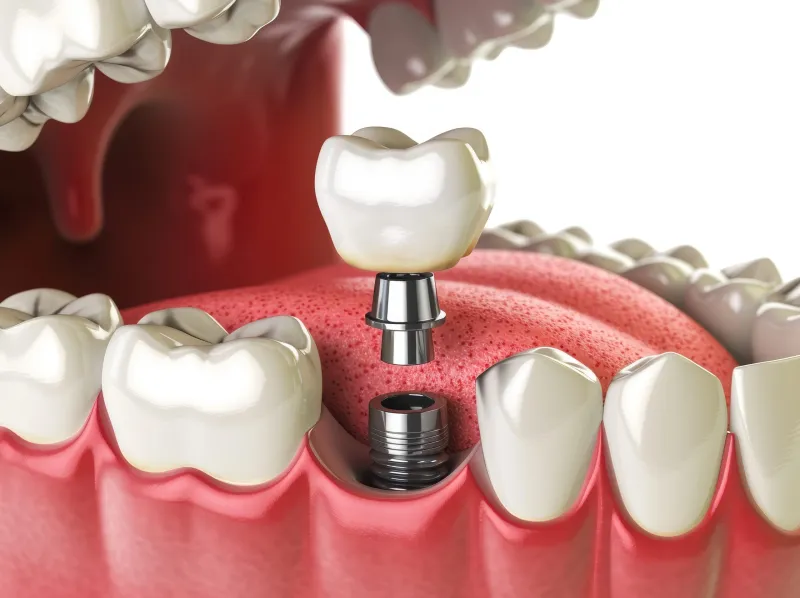 Consultație de implantologie și calcul de preț pentru implant dentar la DaviDent Aesthetics din Sectorul 6