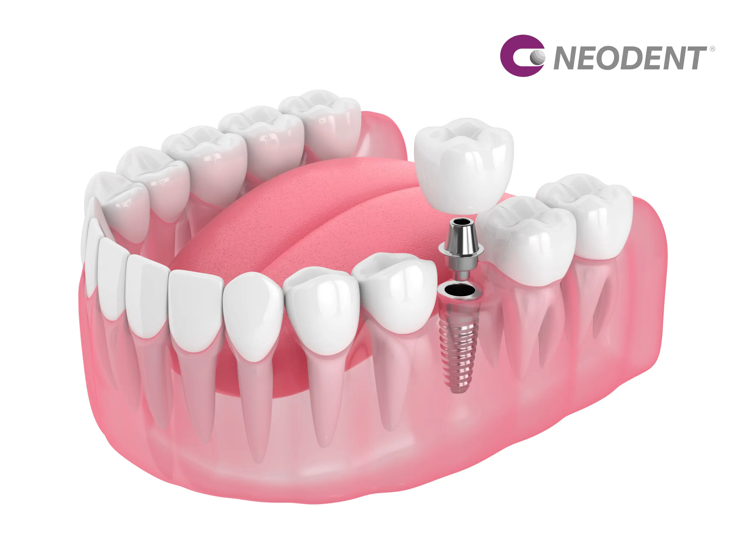Implant Neodent