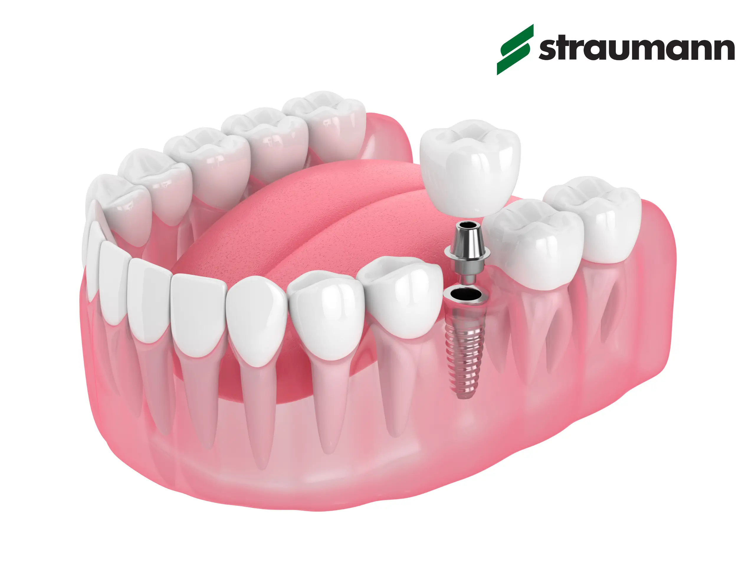 Implant Straumann